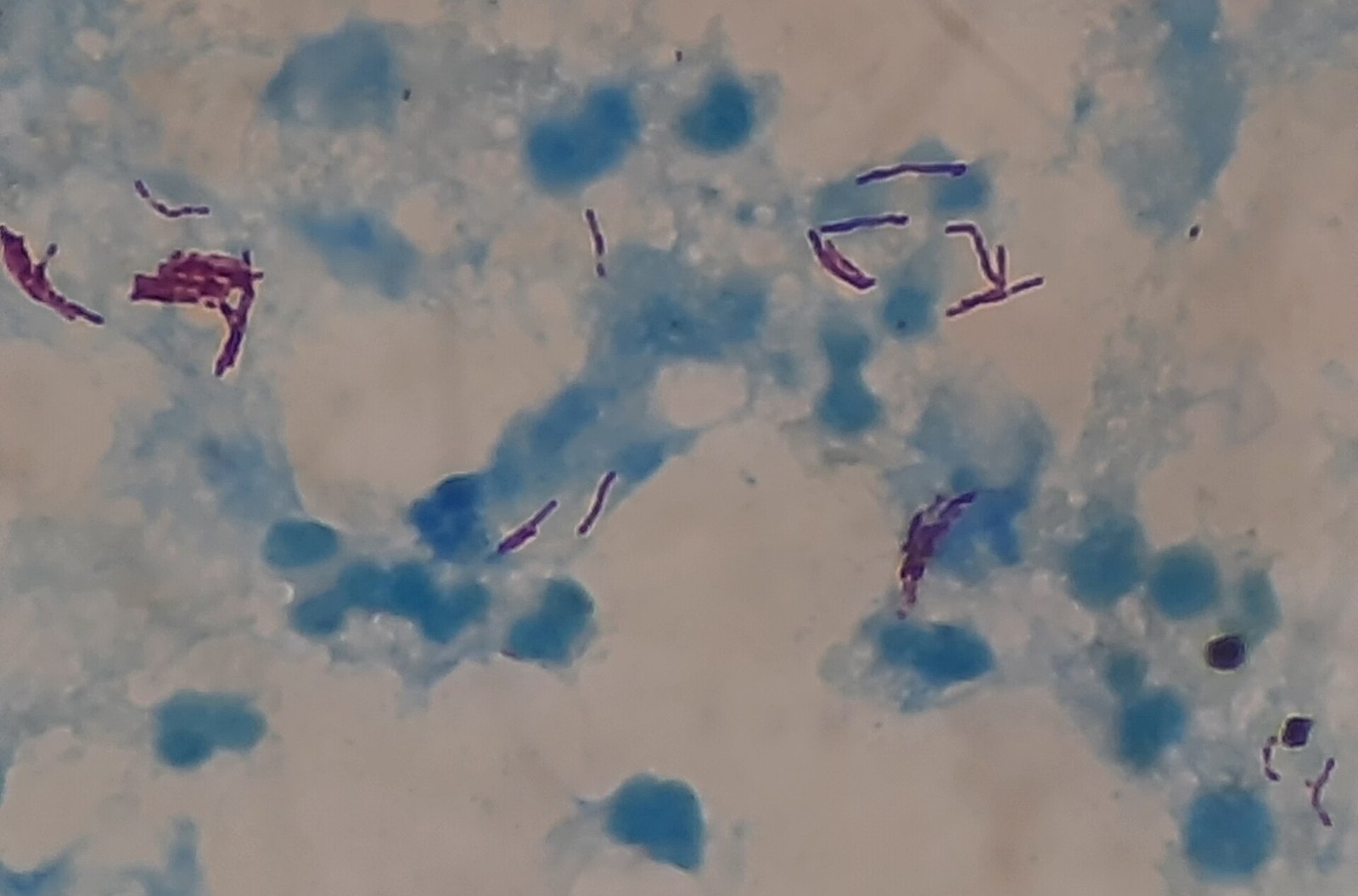 Mycobacterium tuberculosis (bastonetes vermelhos) corados em amostra de expectorado