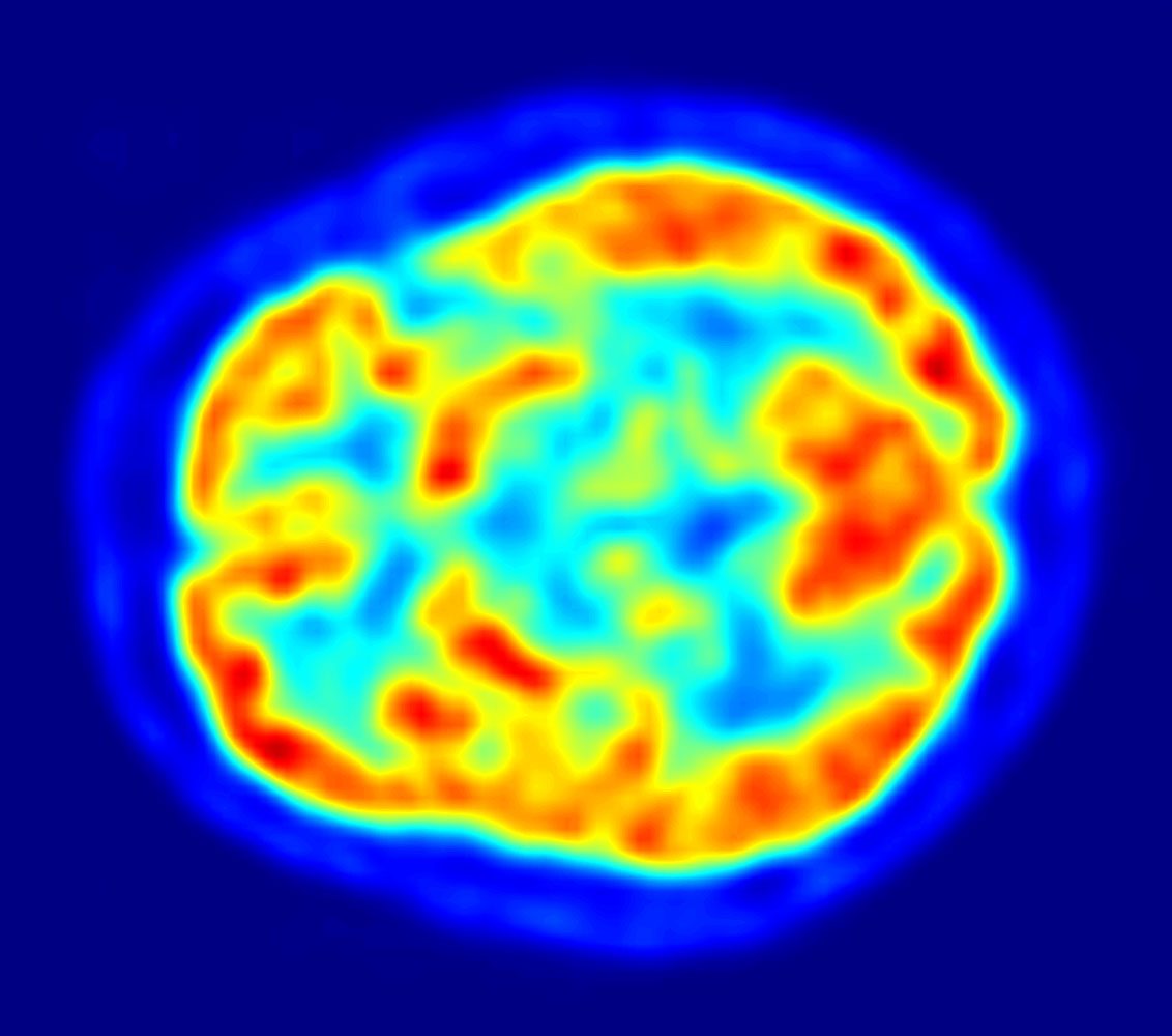 A coloured PET slice of the brain: a blue background with a ring of yellow and red marking where the glucose tracer collected most