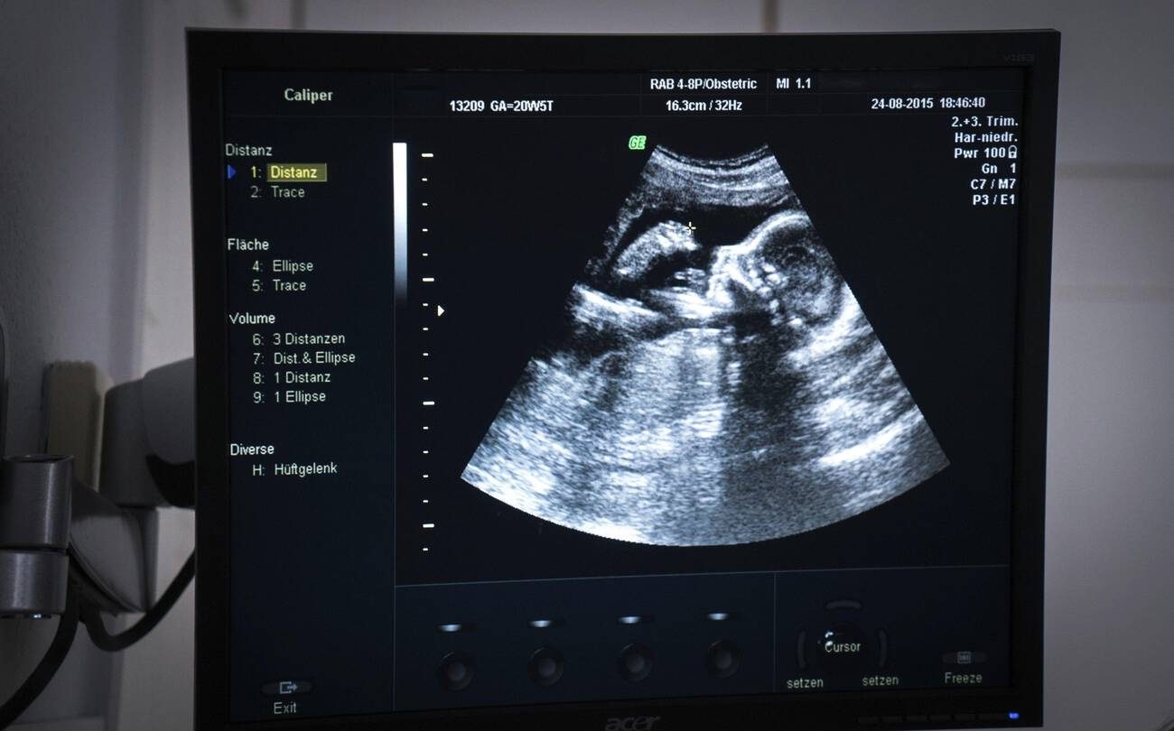 หน้าจอเครื่องอัลตราซาวด์แสดงภาพ scan สีเทารูปพัดของ fetus อายุ 20 สัปดาห์ ในด้านข้าง