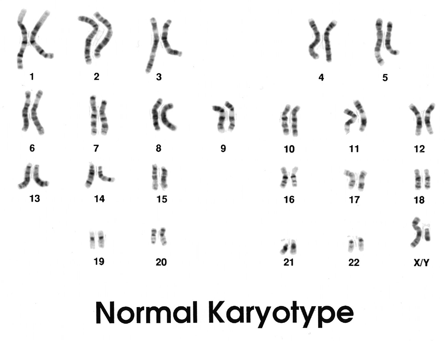 Karyotype ของมนุษย์: 22 คู่ของ autosome plus sex chromosomes